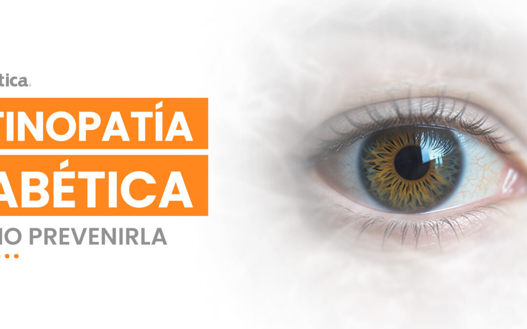 Cómo Prevenir la Retinopatía Diabética: Consejos para Mantener una Visión Saludable